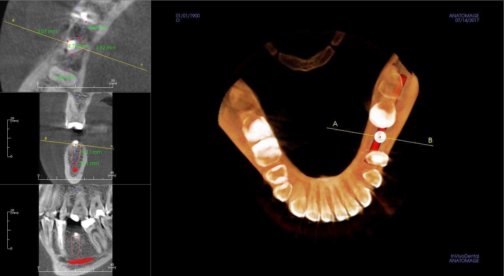 Plánování zubního implantátu pomocí 3D zobrazení